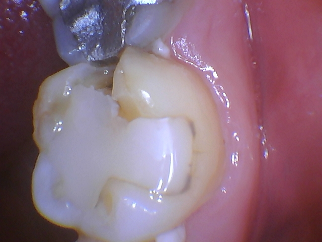 Clinical close-up of a dental restoration