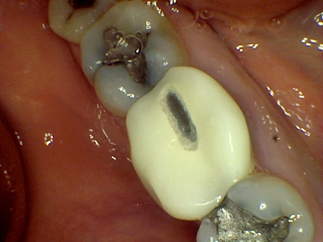Clinical close-up of a dental crown